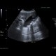 Choledocholithiasis, cholecystolithiasis, gallstones, biliary obstruction: US - Ultrasound